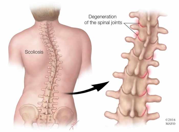 a-medical-illustration-of-a-spine-with-scoliosis-highlighting-degeneration-of-the-spinal-joints-original.jpg