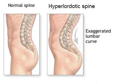 hyperlordosis