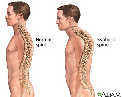 kyphosis