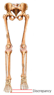 Leglengthdiscrepancy.jpg